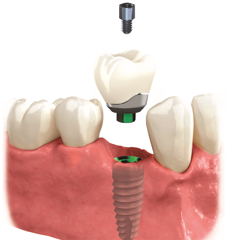 Andy Berwick Dental Implants at No.4 Dental Studio - Dentists in ripon